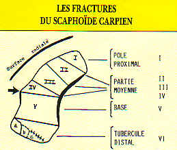 Classification des fractures du scaphode.