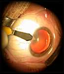 La cataracte, intervention, chirurgie, opération, cataracte