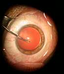 La cataracte, intervention, chirurgie, opération, cataracte